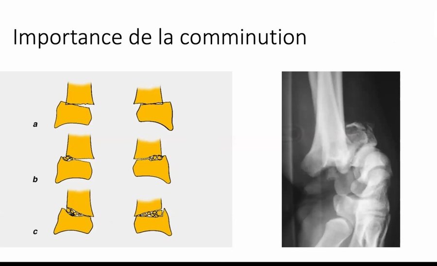 Radiographies avant et après réduction d'une fracture de Pouteau-Colles