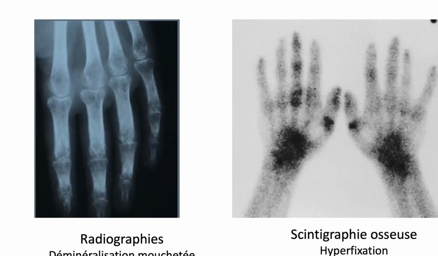 Radiographie montrant une déminéralisation mouchetée et scintigraphie osseuse montrant une hyperfixation des deux mains