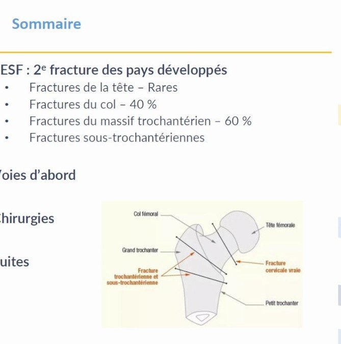 Anatomie de l'extrémité supérieure du fémur et localisation des traits de fracture