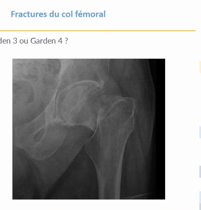 Classification de Pauwels selon la verticalité du trait de fracture