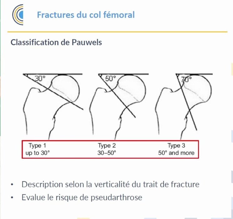 Radiographie de hanche montrant une fracture cervicale vraie déplacée