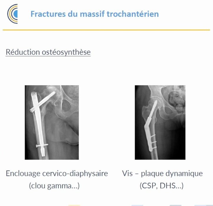 Radiographies post-opératoires : enclouage cervico-diaphysaire (clou gamma) et vis-plaque dynamique (DHS)