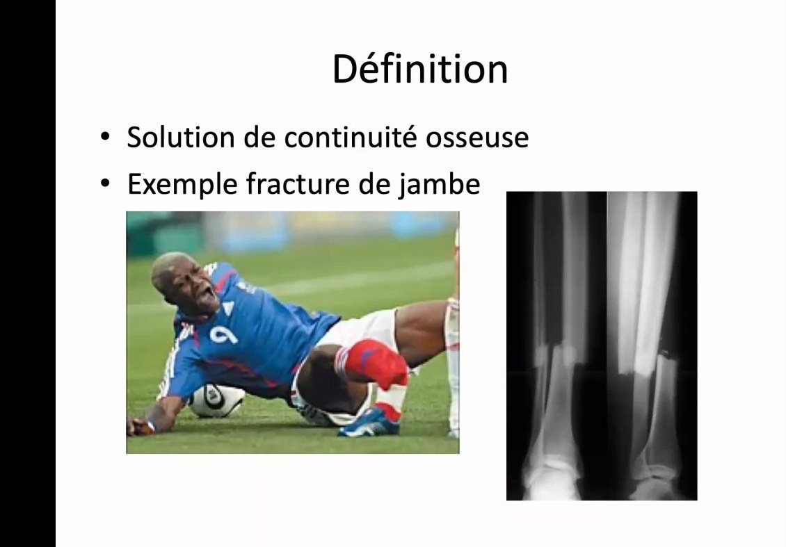 Définition d'une fracture et exemple radiographique