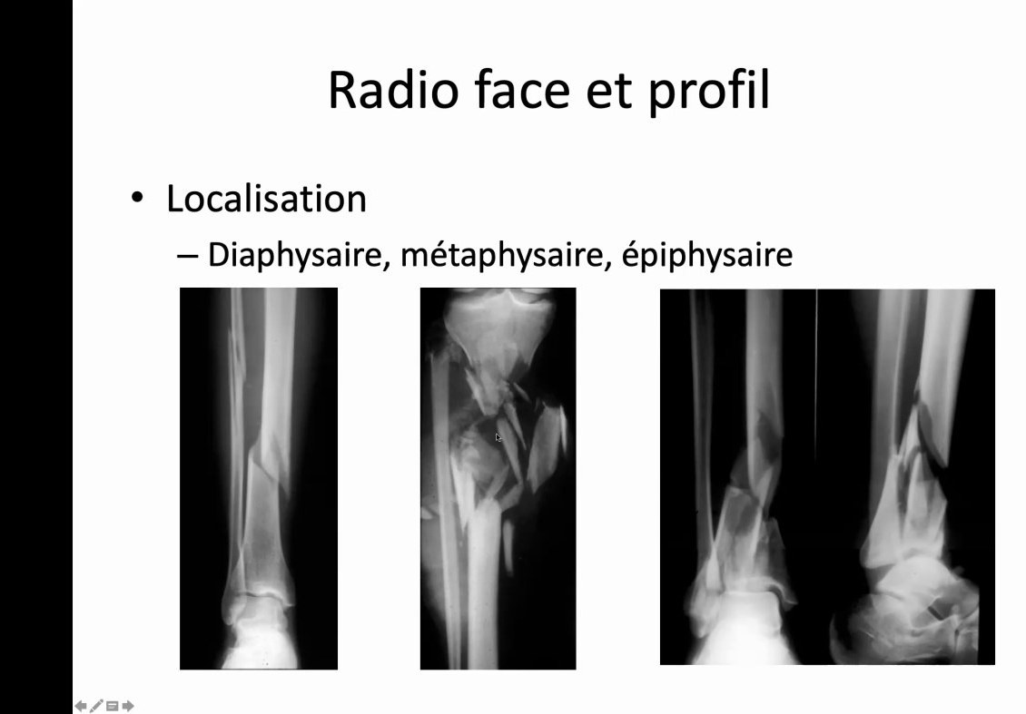 Radiographies de face et de profil de fractures