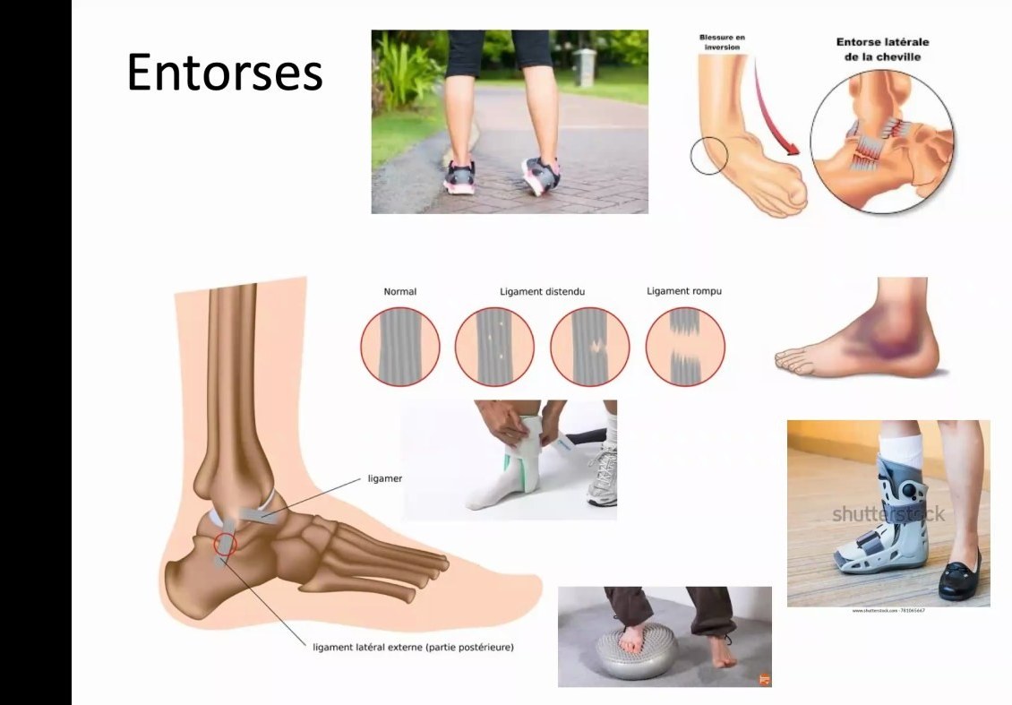 Illustrations d'entorses et immobilisations fonctionnelles