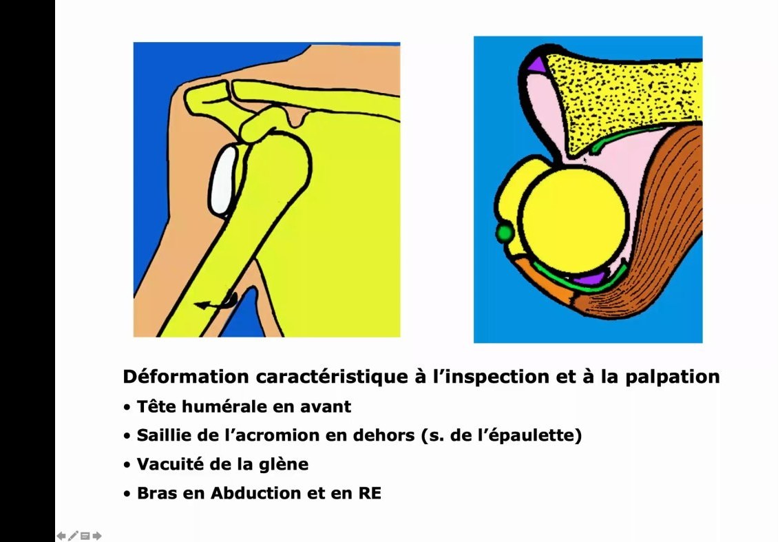 Schéma et imagerie de luxation antérieure de l'épaule