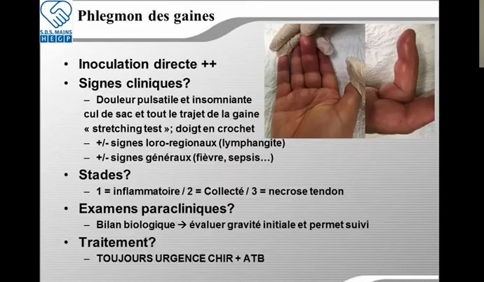 Phlegmon des gaines des fléchisseurs avec signes cliniques
