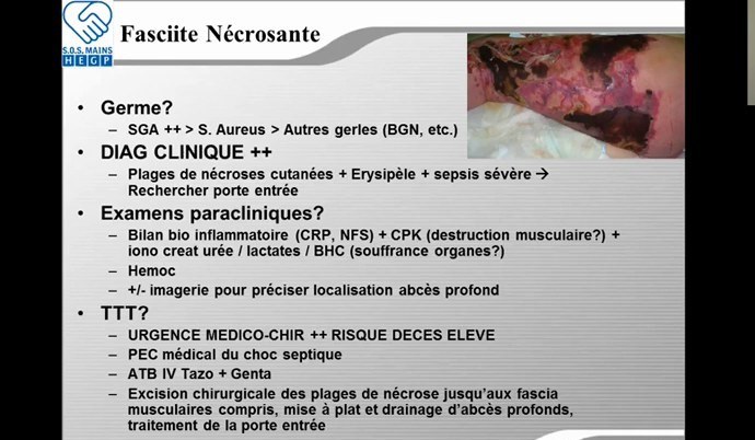 Fasciite nécrosante avec rappel des germes et de la prise en charge