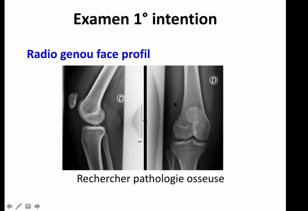 Radiographies et examen initial du genou traumatique