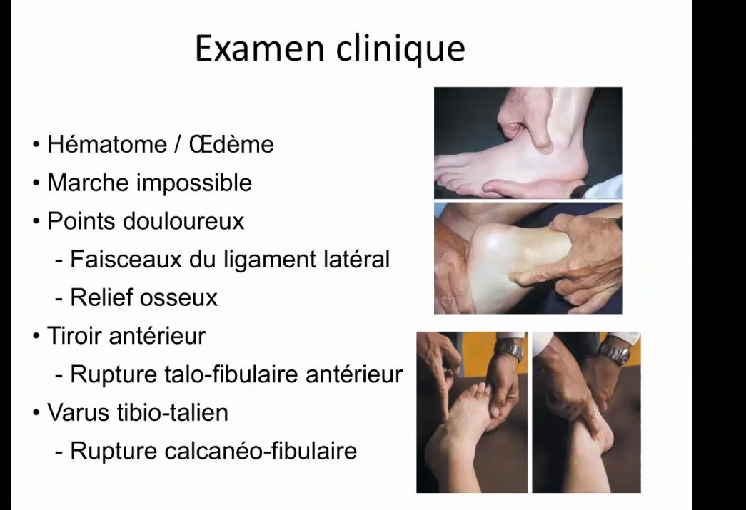 Examen clinique de la cheville après traumatisme
