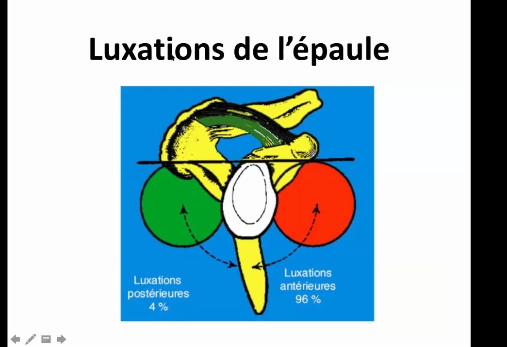 Schéma des directions de luxation gléno-humérale