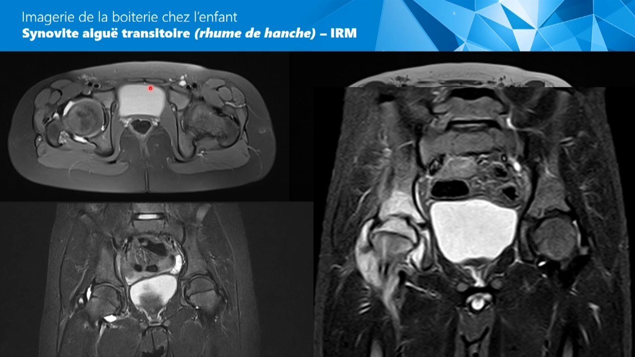 IRM de hanche chez l'enfant avec suspicion d'infection ostéoarticulaire