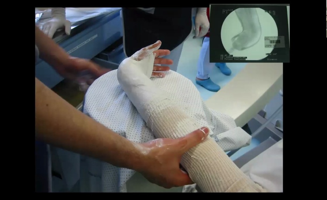 Confection d'une immobilisation plâtrée chez l'enfant
