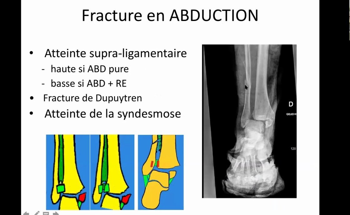 Fracture pédiatrique du coude en abduction avec atteinte supraligamentaire