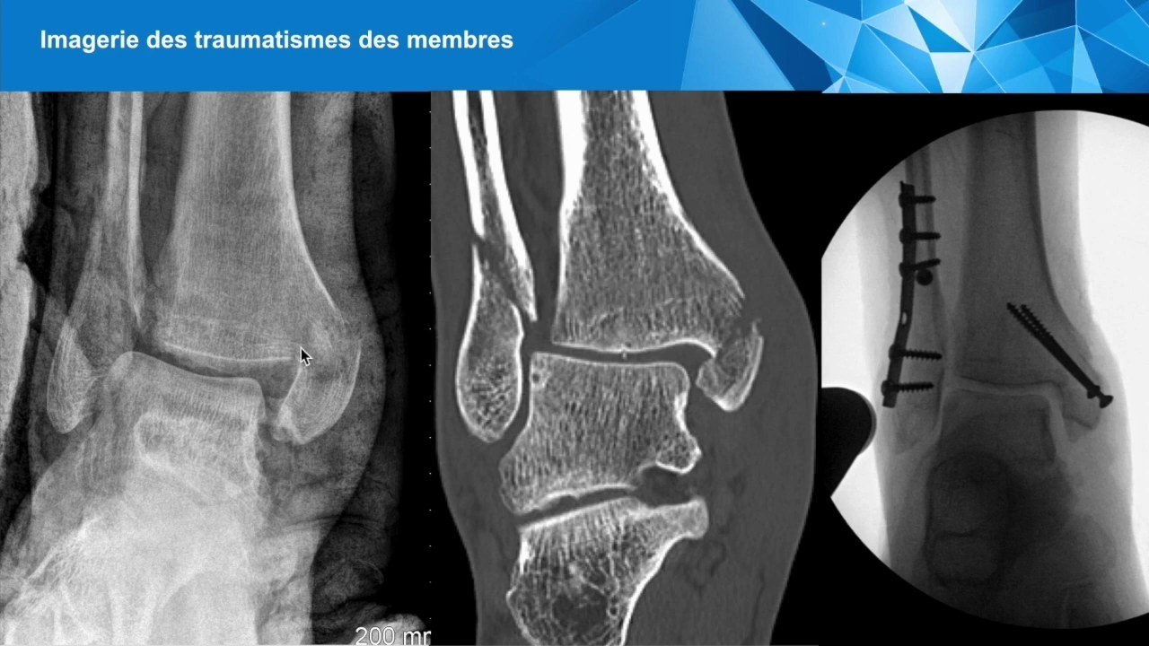 Radiographies de fractures traumatiques des membres et du bassin