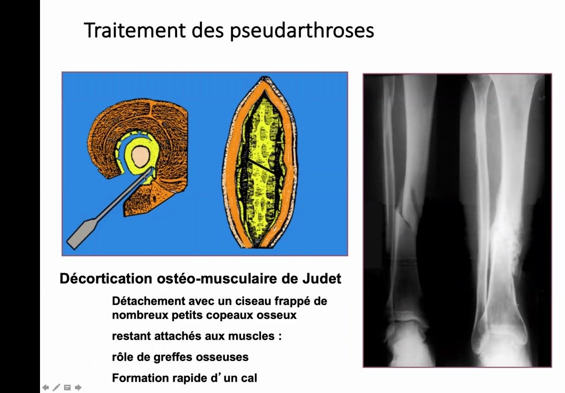 Traitement des pseudarthroses avec décortication ostéo-musculaire