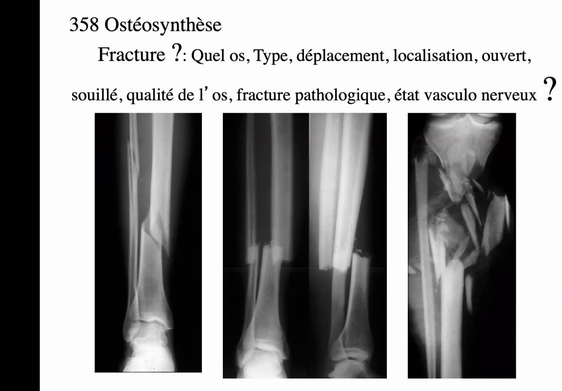 Radiographies illustrant type et déplacement de fracture