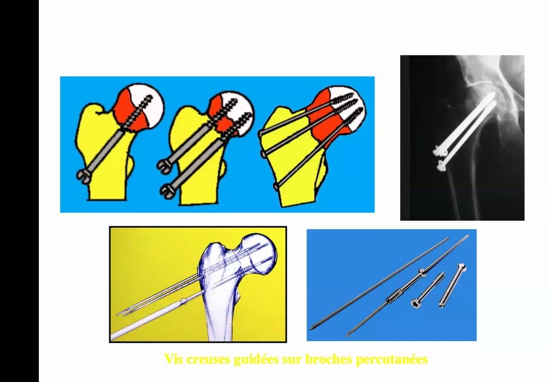 Broches, vis et principes de montage d'ostéosynthèse