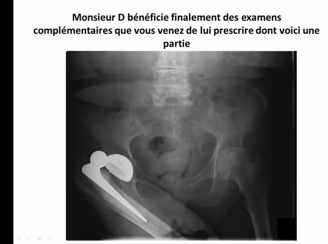 Radiographie de luxation de prothèse de hanche