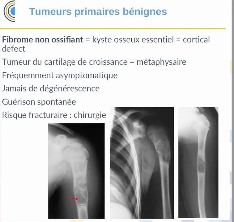 Fibrome non ossifiant et kyste osseux essentiel