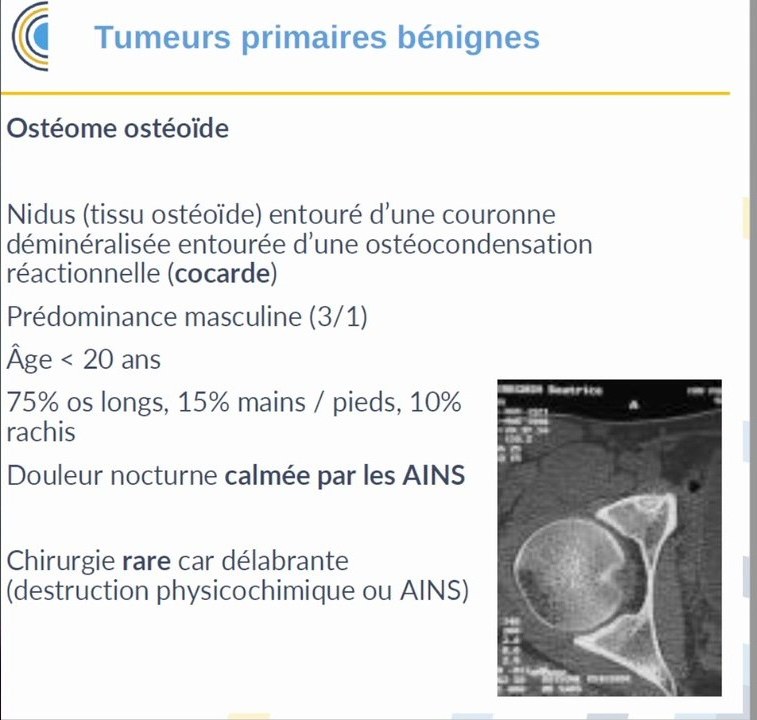 Ostéome ostéoïde avec nidus et ostéocondensation