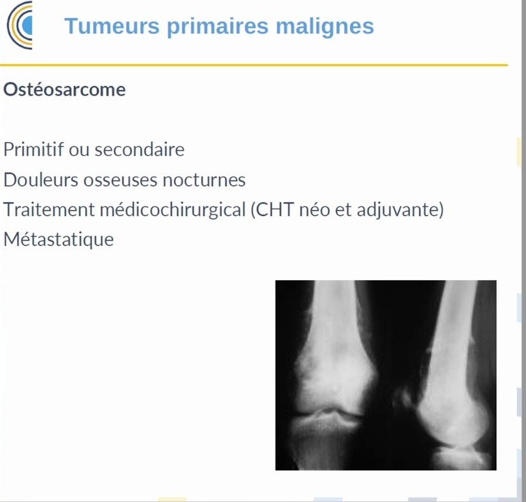Ostéosarcome avec radiographie de lésion agressive