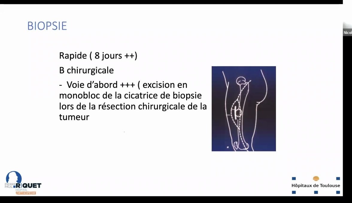 Principe de trajet de biopsie d'une tumeur osseuse