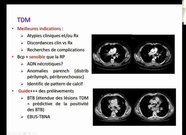 Atteintes Respiratoires des Connectivités et Vascularites