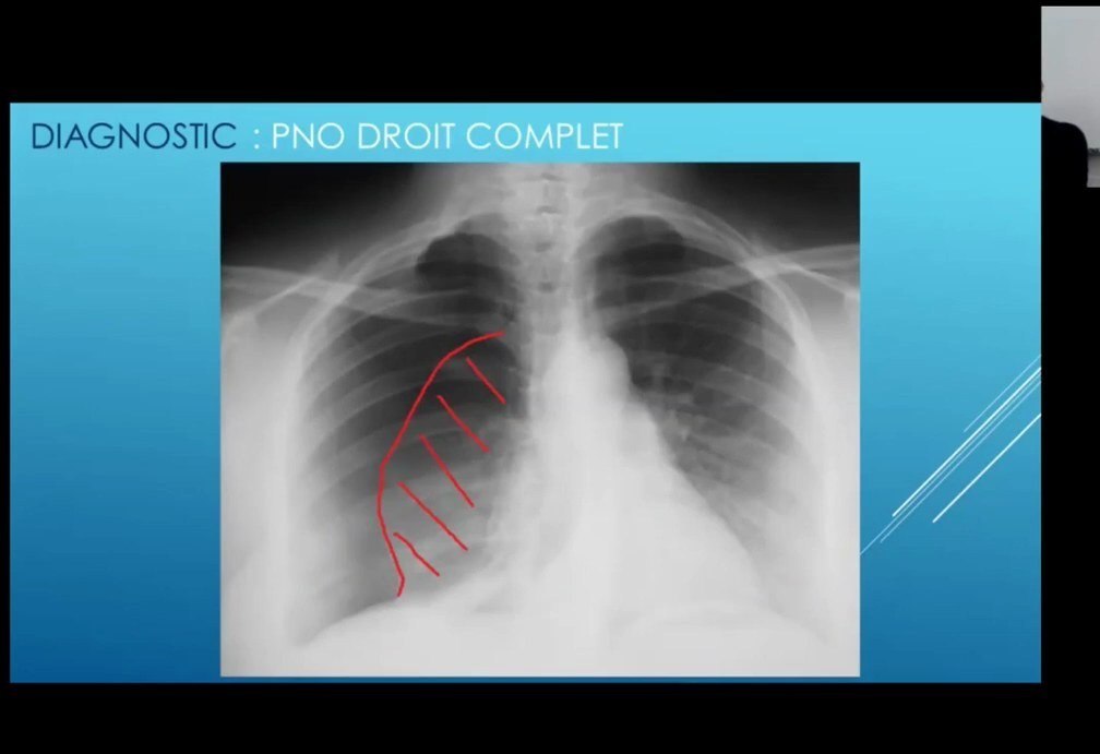 Épanchement Pleural