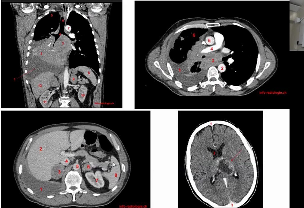 Infections Broncho-Pulmonaires Communautaires