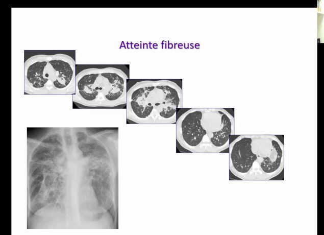Pathologies Interstitielles Diffuses