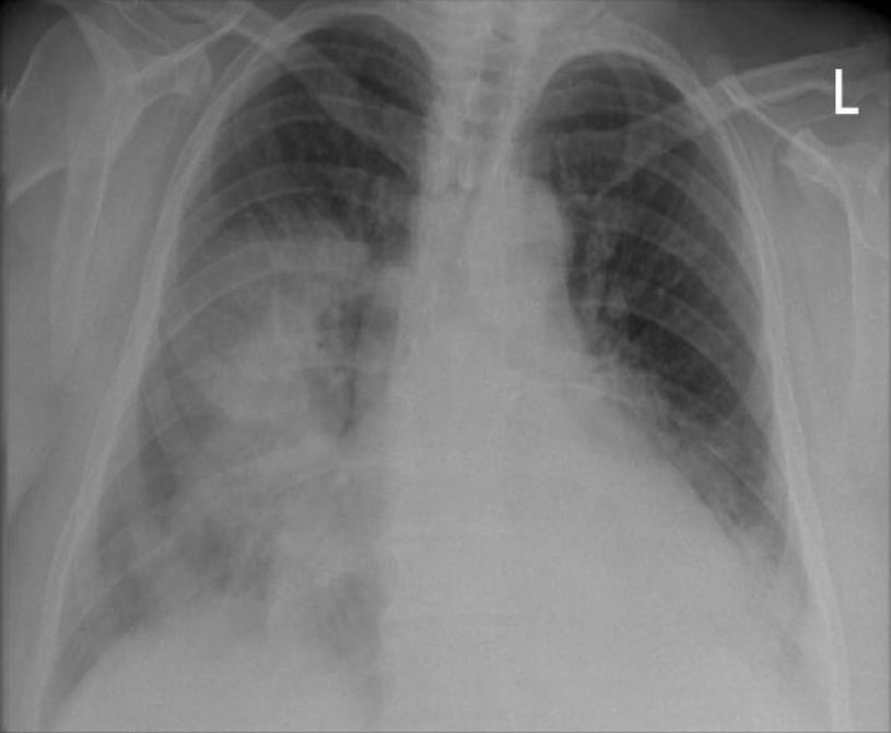 Radiographie thoracique — pneumopathie