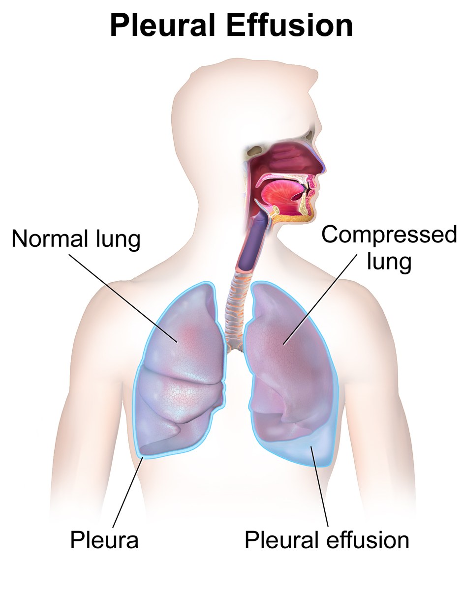 Radiographie — épanchement pleural