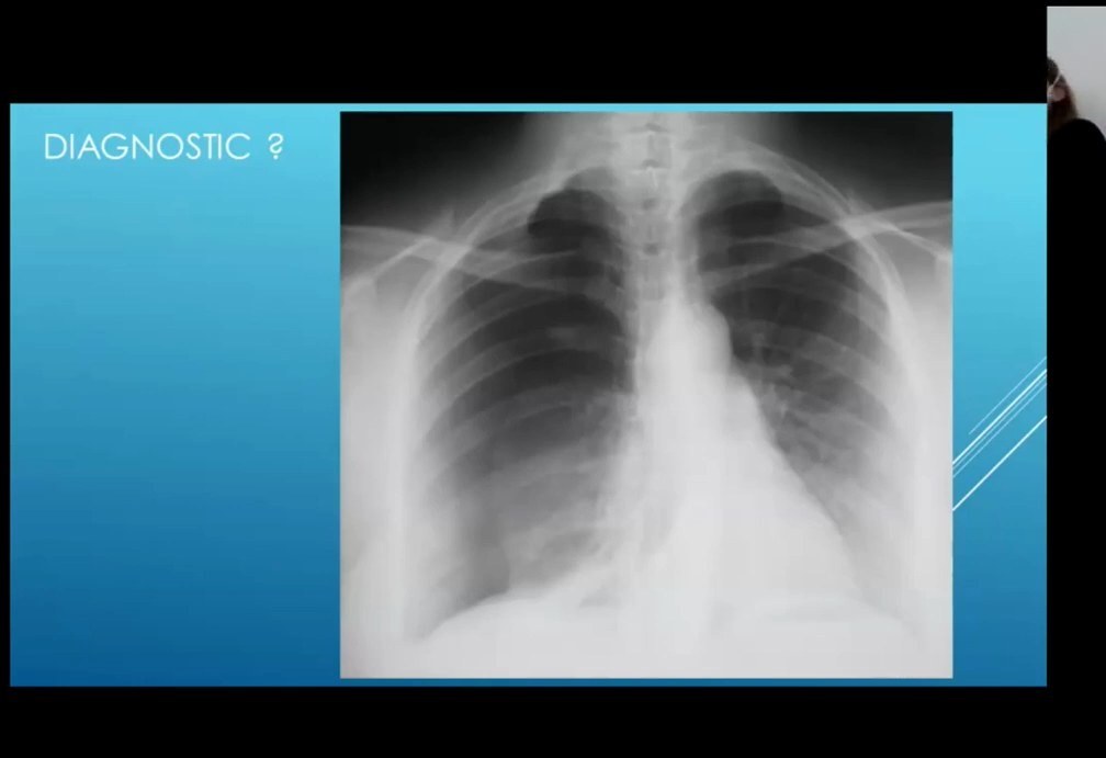 Pneumothorax