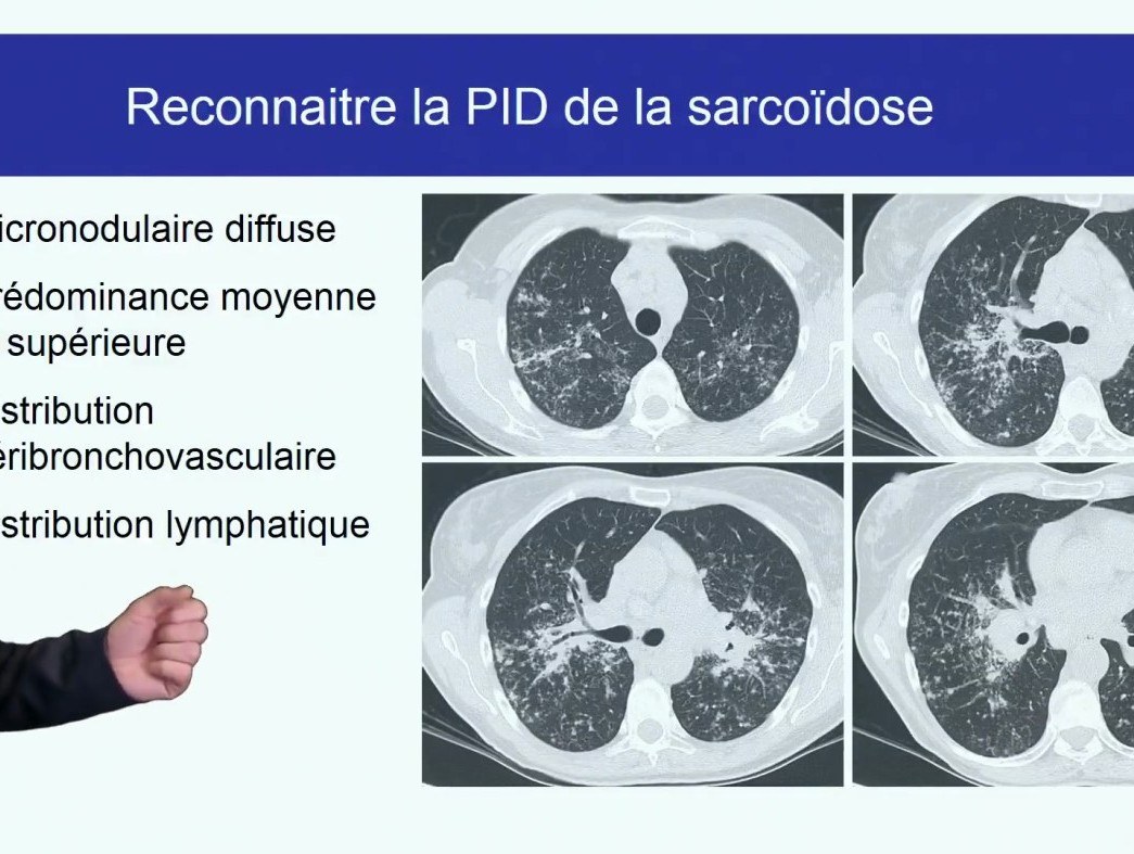 Sarcoïdose
