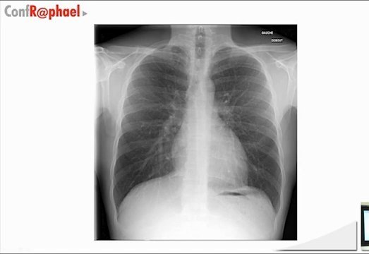 Radiographie thoracique et repères de lecture
