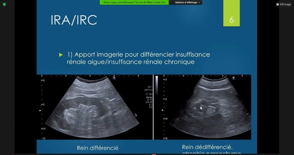Échographie rénale comparative