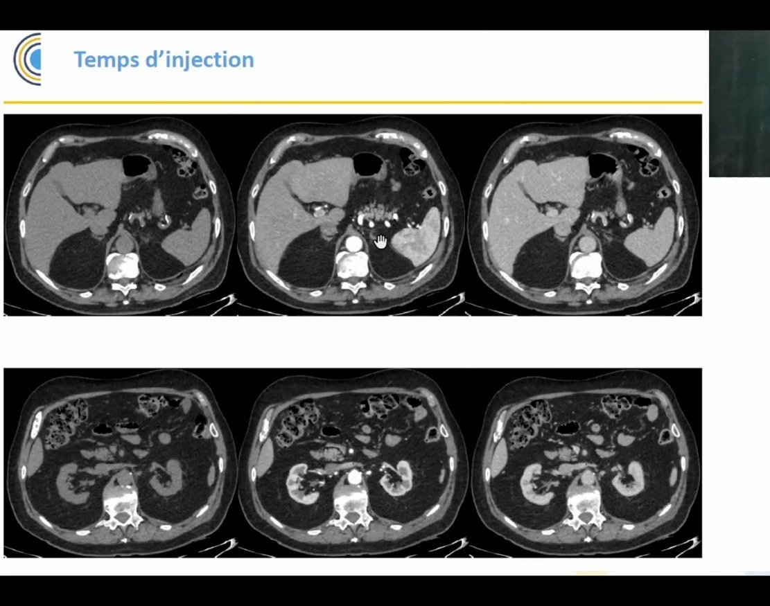 Temps d'injection au scanner