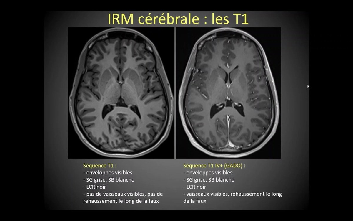 Séquences IRM cérébrales