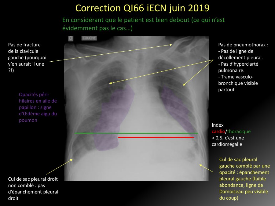 Correction de radiographie thoracique