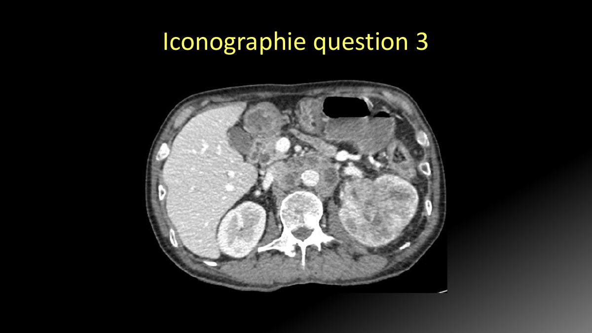 Scanner abdominal de cas