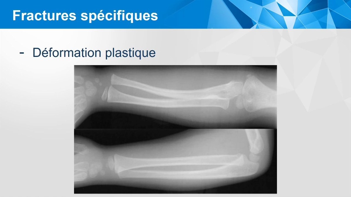 Radiographie de fracture de l'enfant