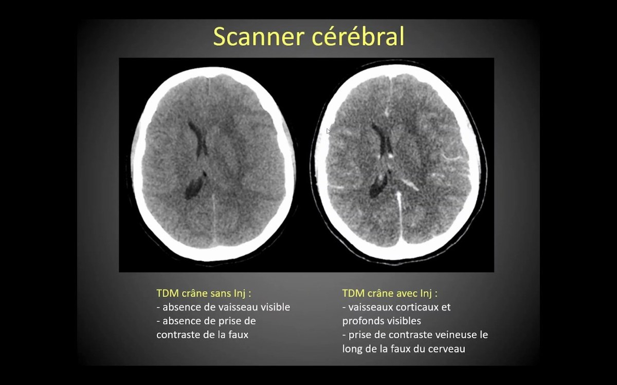 Scanner cérébral d'urgence