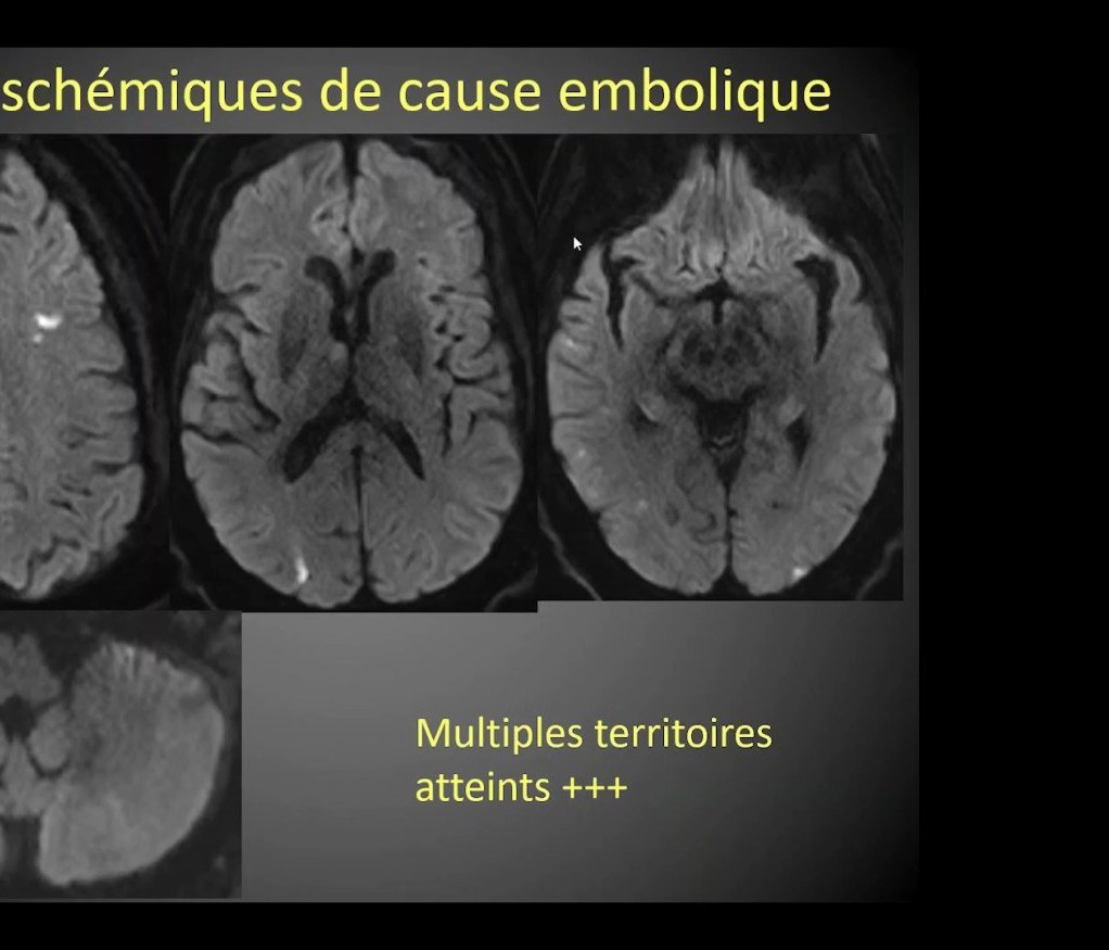 AVC ischémique de circulation postérieure
