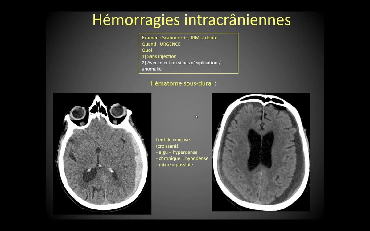 Hémorragies intracrâniennes au scanner
