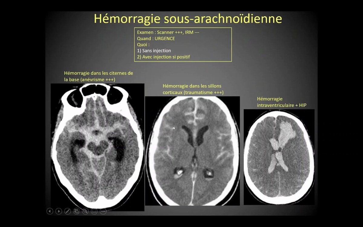 Hémorragie sous-arachnoïdienne et angioscanner