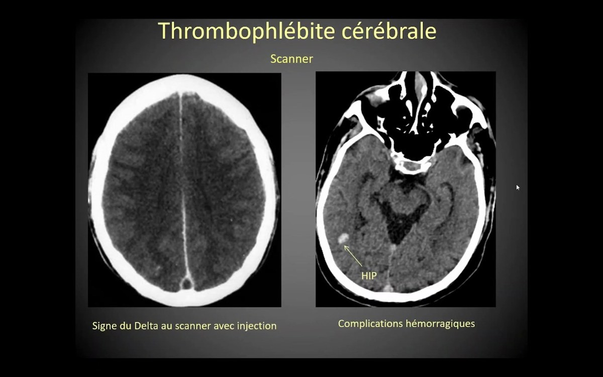 Thrombophlebite cérébrale