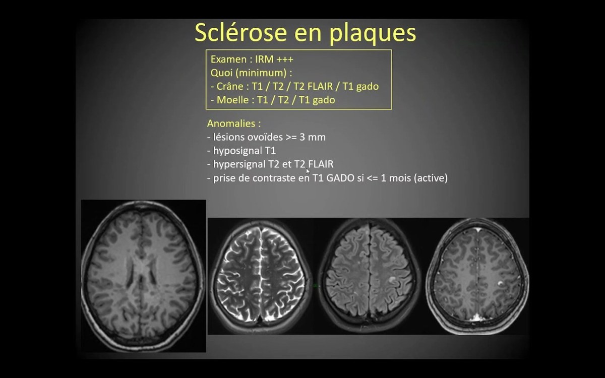 IRM de sclérose en plaques