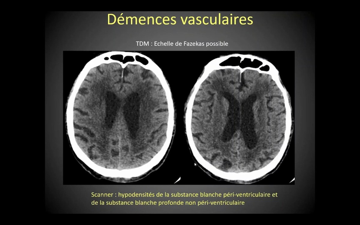 Démence vasculaire au scanner