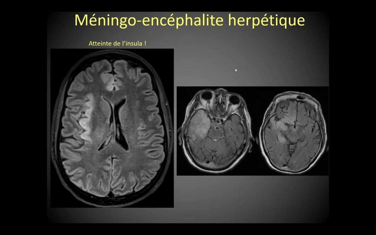 Meningo-encéphalite herpétique en IRM